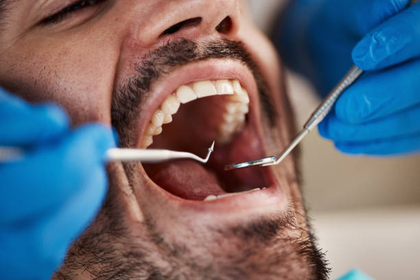 Best Emergency Dentist for Lost Fillings or Crowns in Morgantown, IN